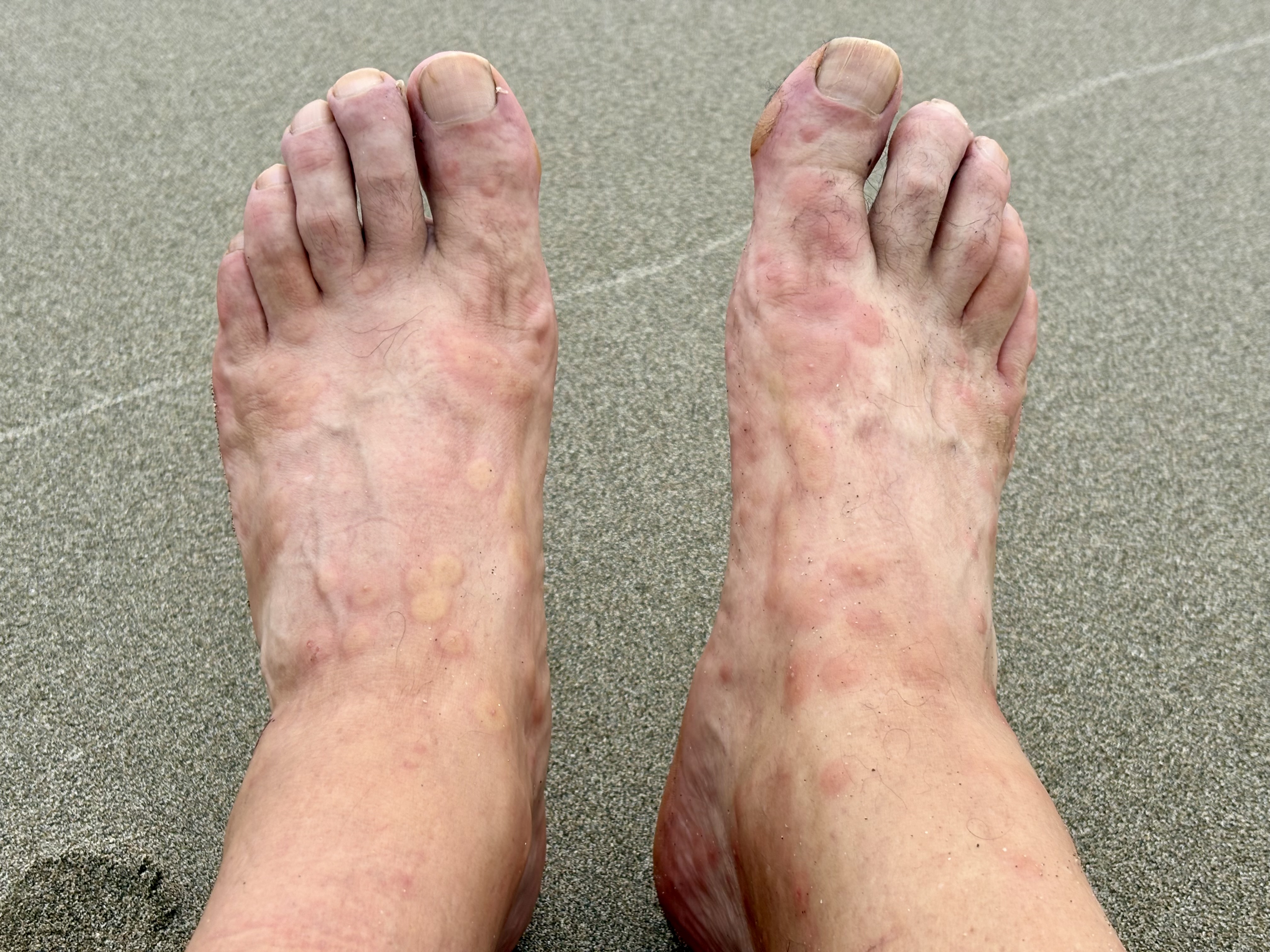 Pieds avec piqûres de fourmis